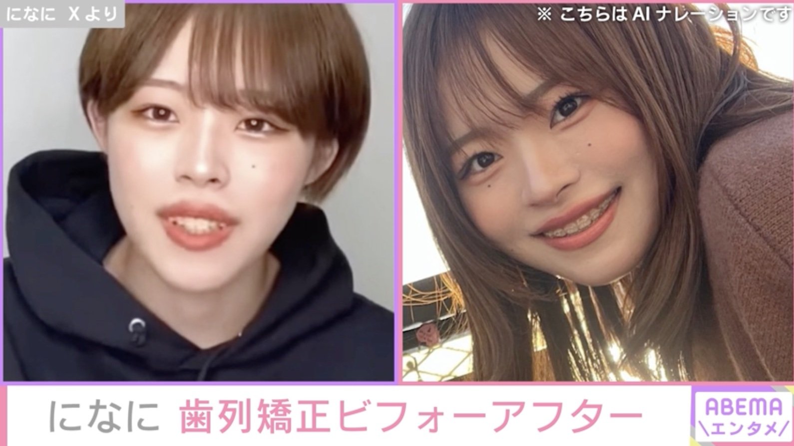 芸能人 歯 ビフォー アフター